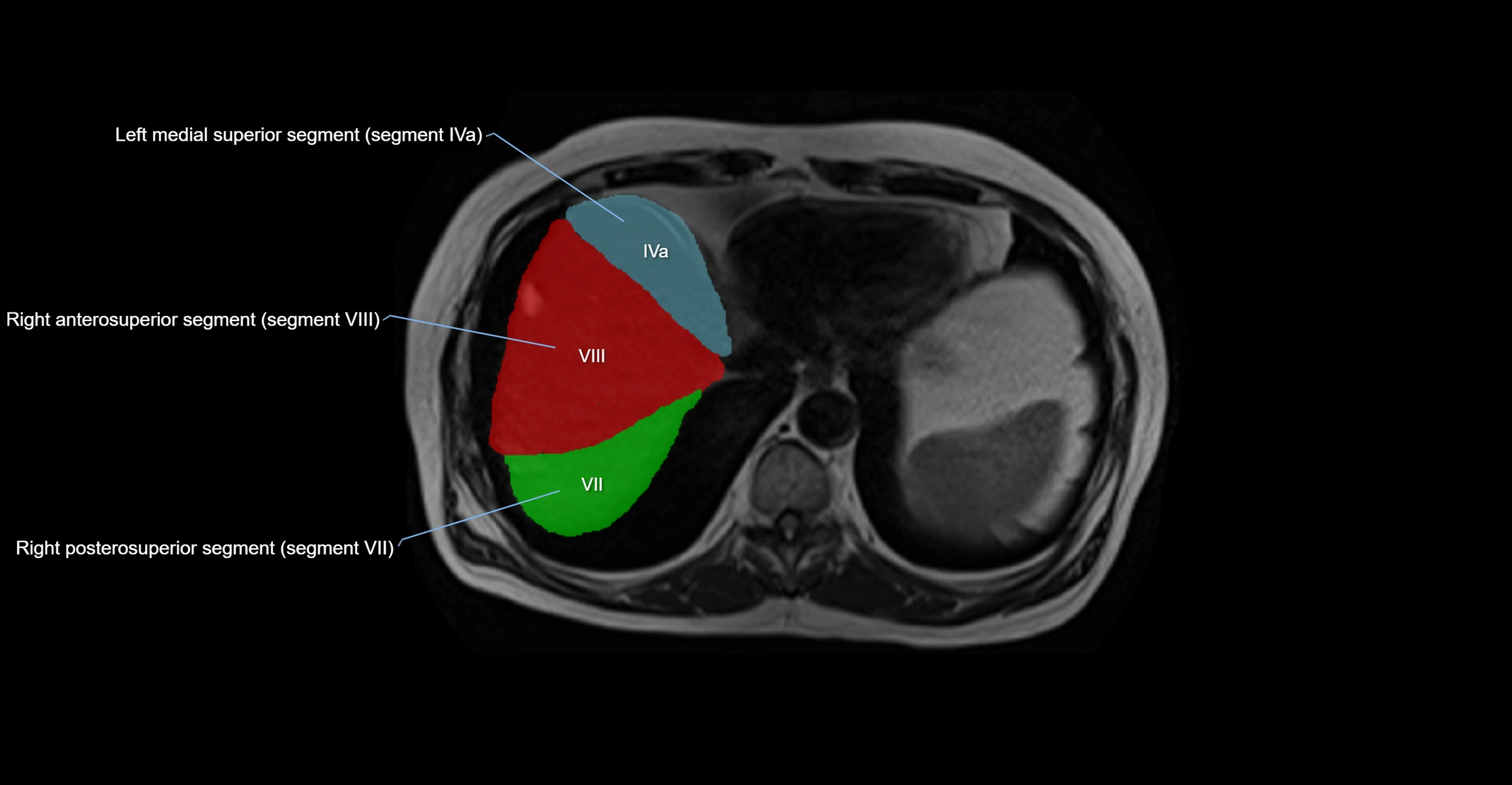 MRI  liver segments anatomy axial cross sectional 3T radiology  image-img-00001-00005.webp